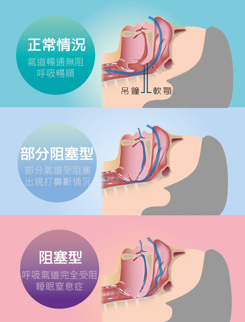 泓博醫療 Honor Health Medical 專業鼻鼾治療