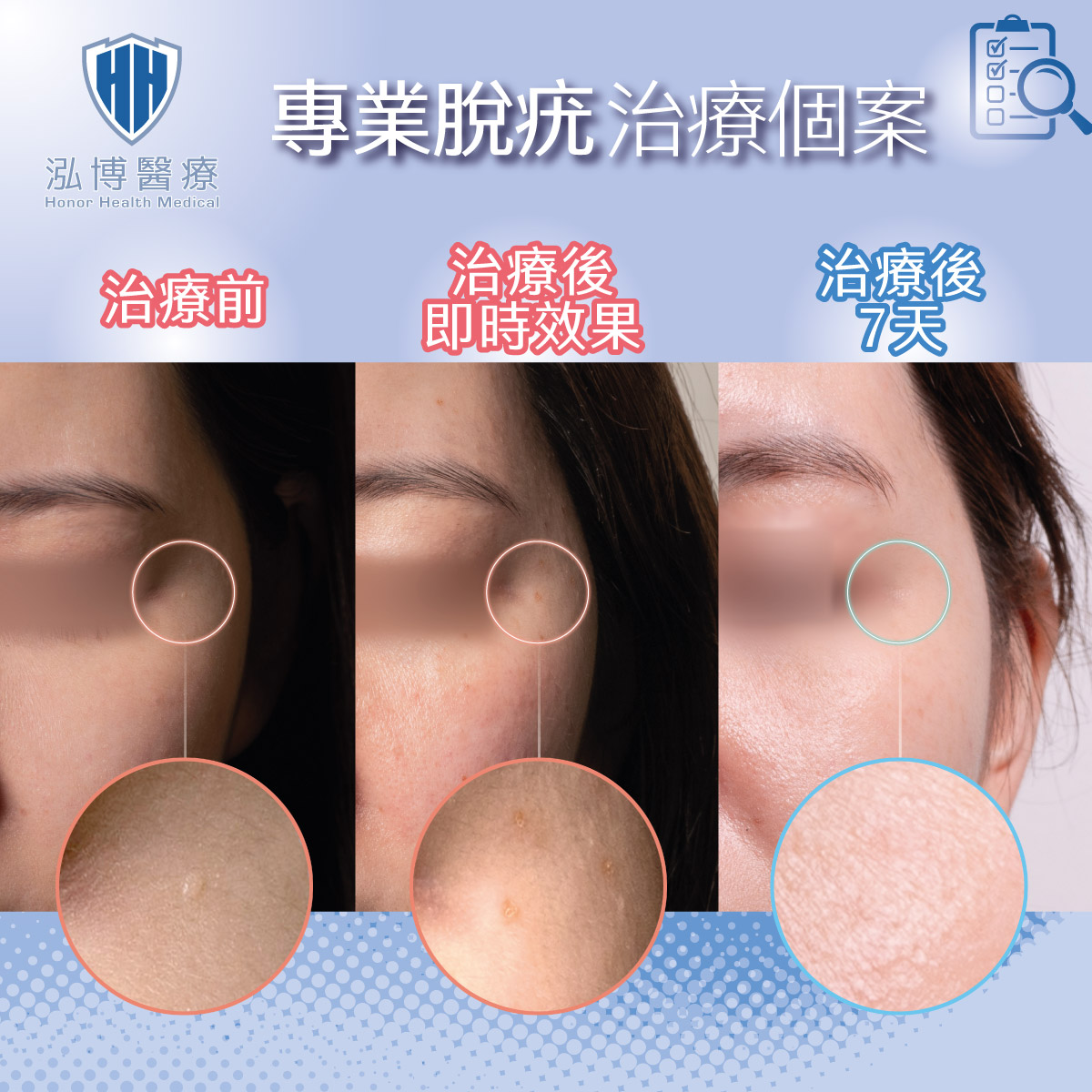 專業脫疣治療個案1