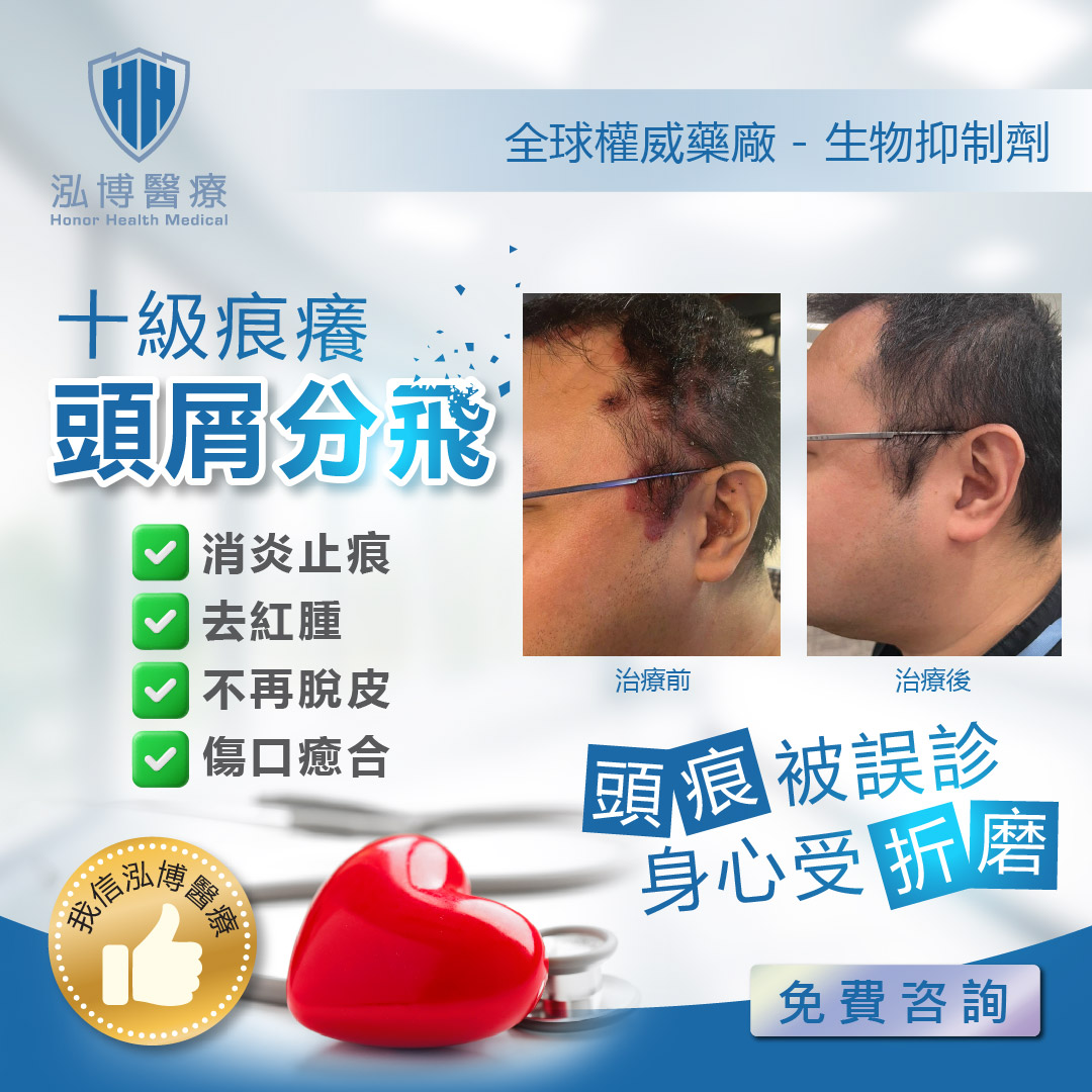 改善皮膚問題困擾-頭皮牛皮癬