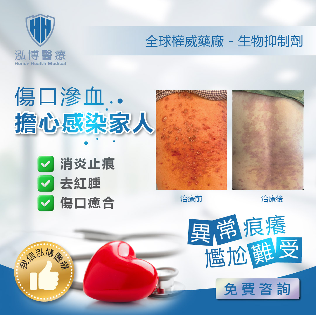 改善皮膚問題困擾-牛皮癬