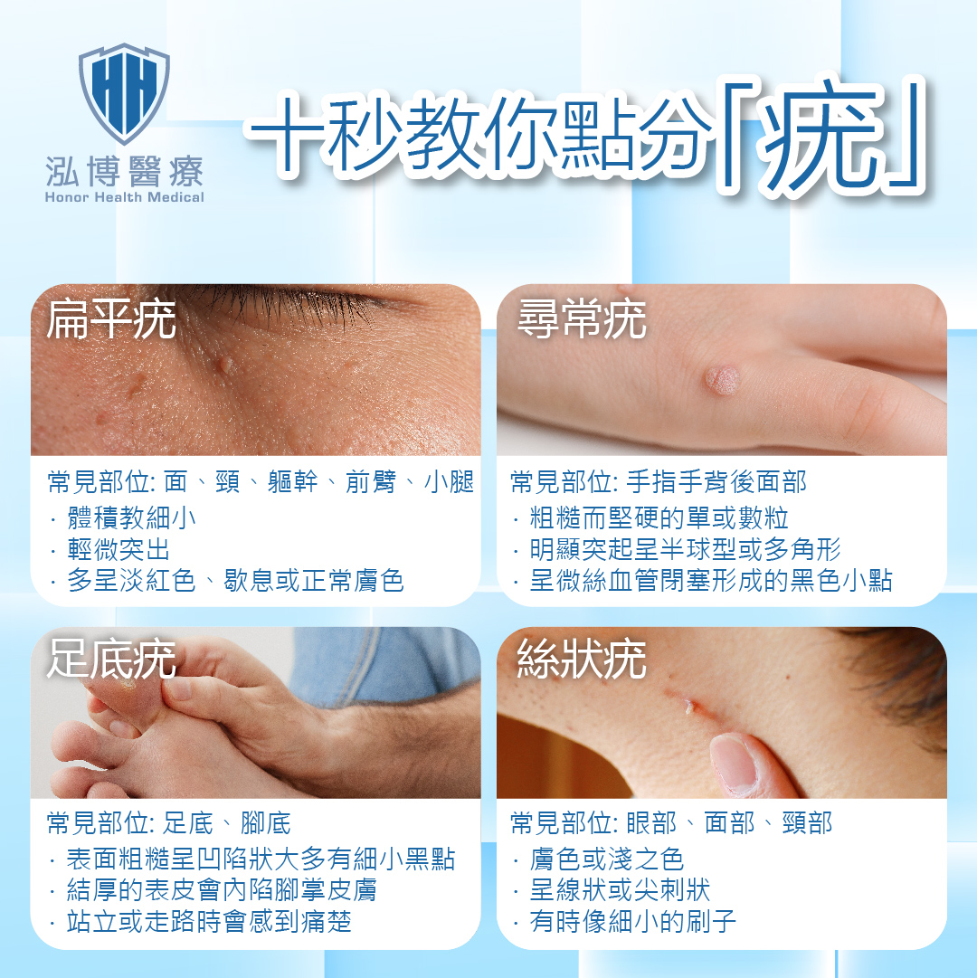 十秒教你點分疣
