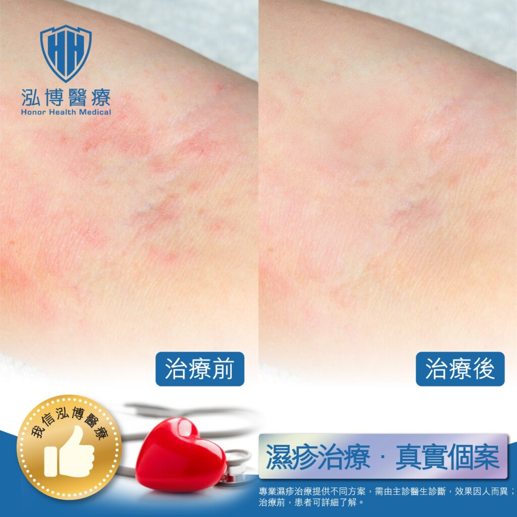 濕疹治療案例