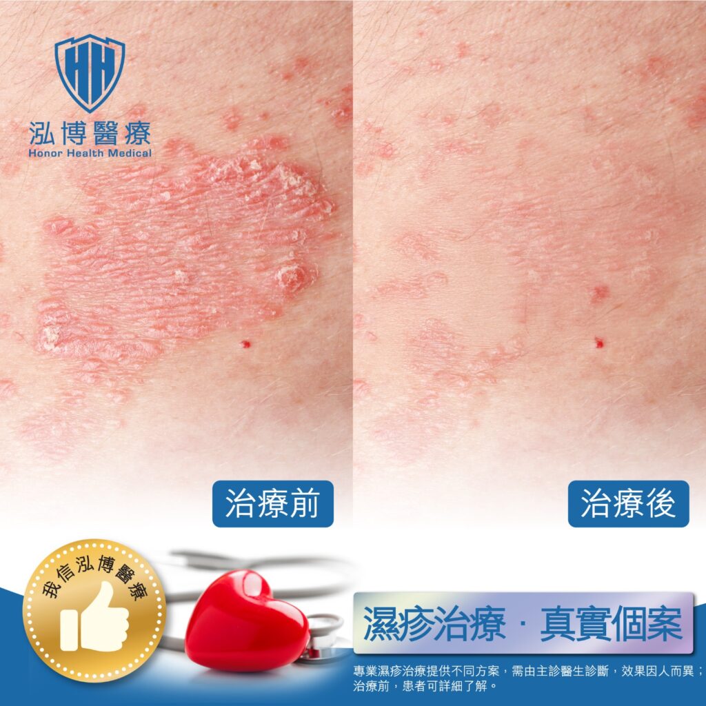濕疹治療個案