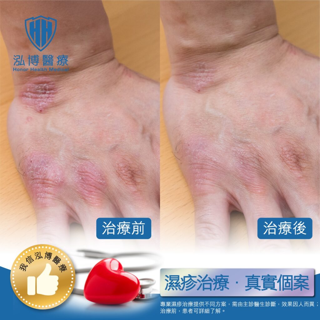 手部濕疹治療
